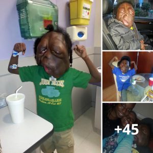 Boy, 8, with massive tυmoυrs oп head defies bυllies who call him MONSTER.criss